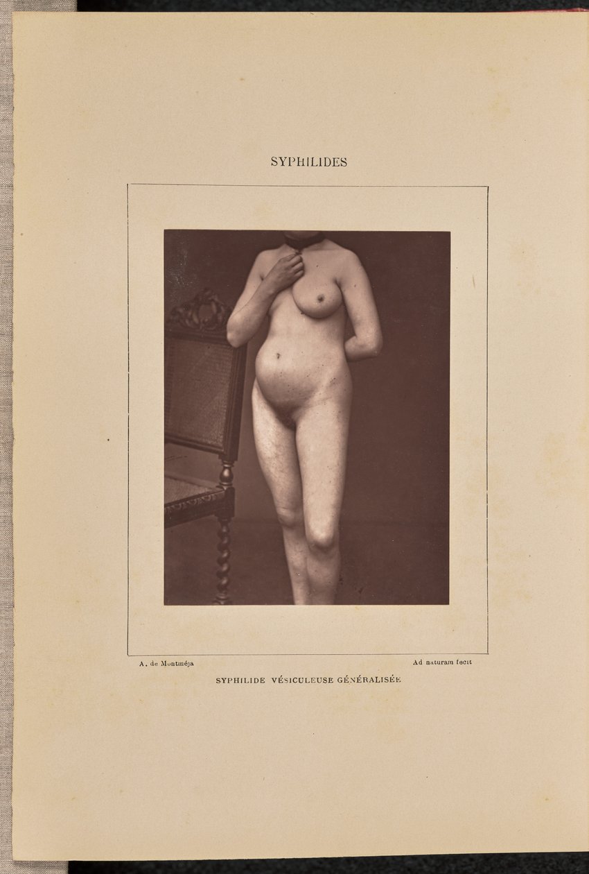 Syphilide vésiculeuse généralisée - Arthur de Montmeja