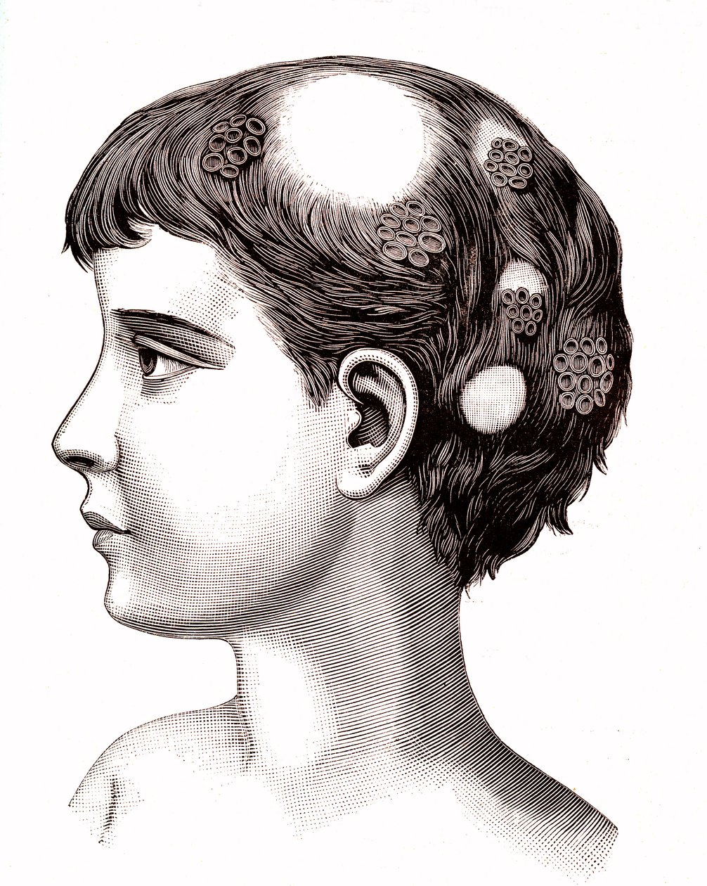 Teigne sur un enfant. 1887 (gravure) - French School