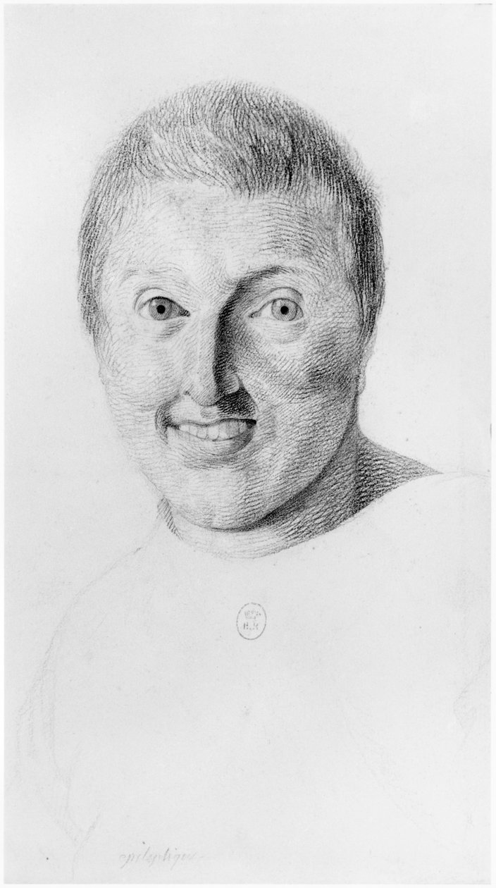 Femme épileptique, vue de face, illustration d