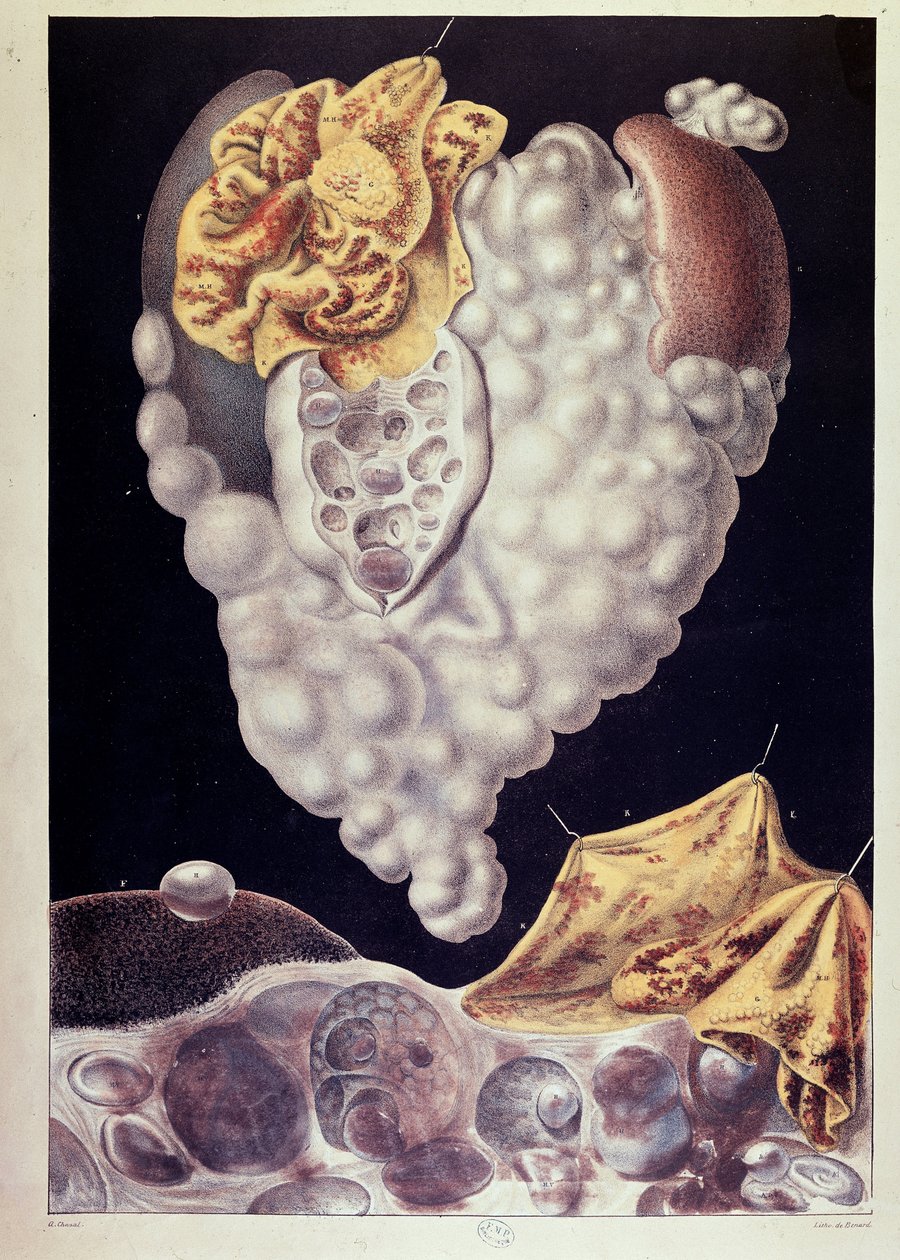 Cancer - de Cruveilhier - Jean Cruveilhier