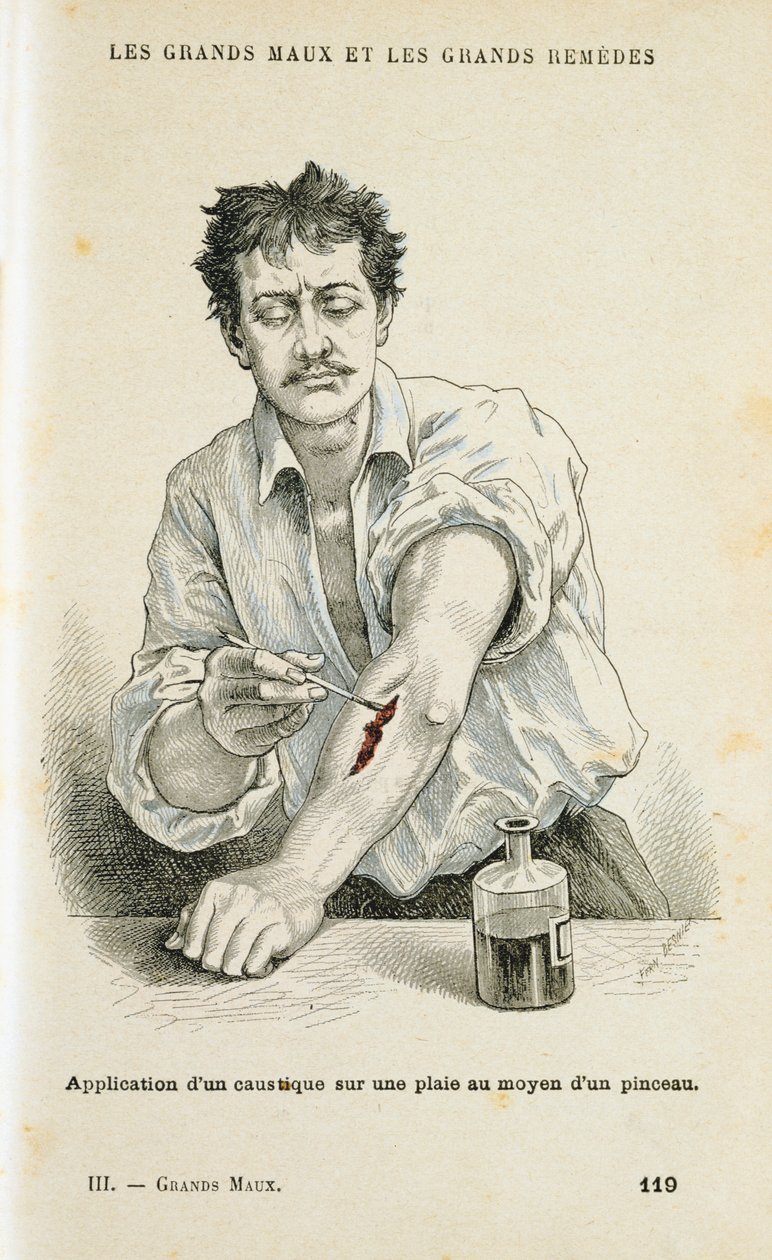 Peindre une plaie avec une solution antiseptique, vers 1890 - Unbekannt