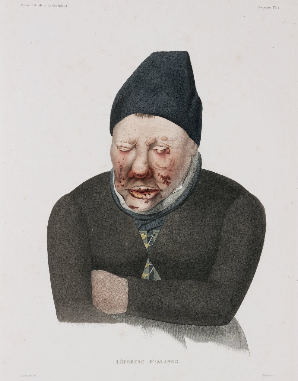 Maladies, Lèpre - Unbekannt