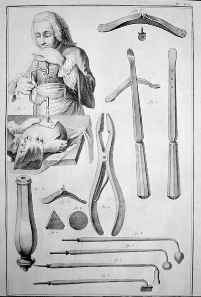 Trépanation du crâne, divers instruments (gravure) - Unknown artist