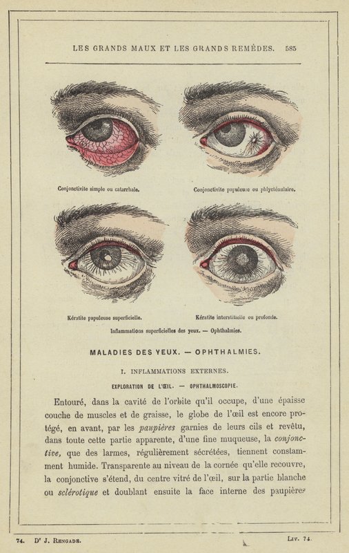 Inflammations superficielles des yeux, Ophthalmies - French School