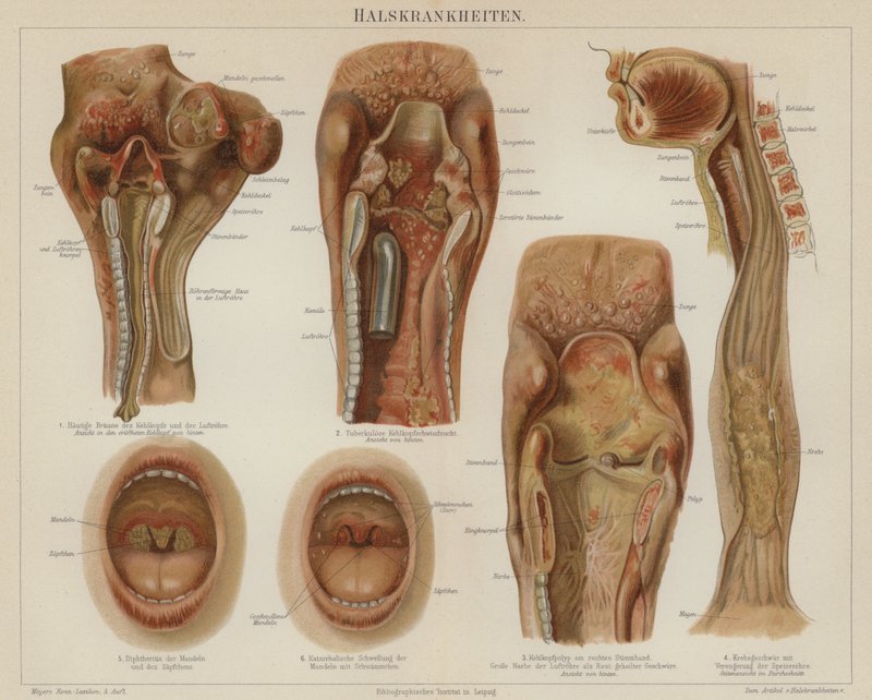 Maladies de la gorge - German School